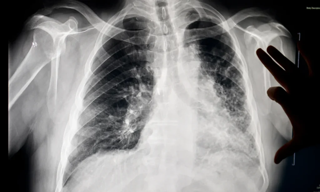 Silicosis X-Ray
